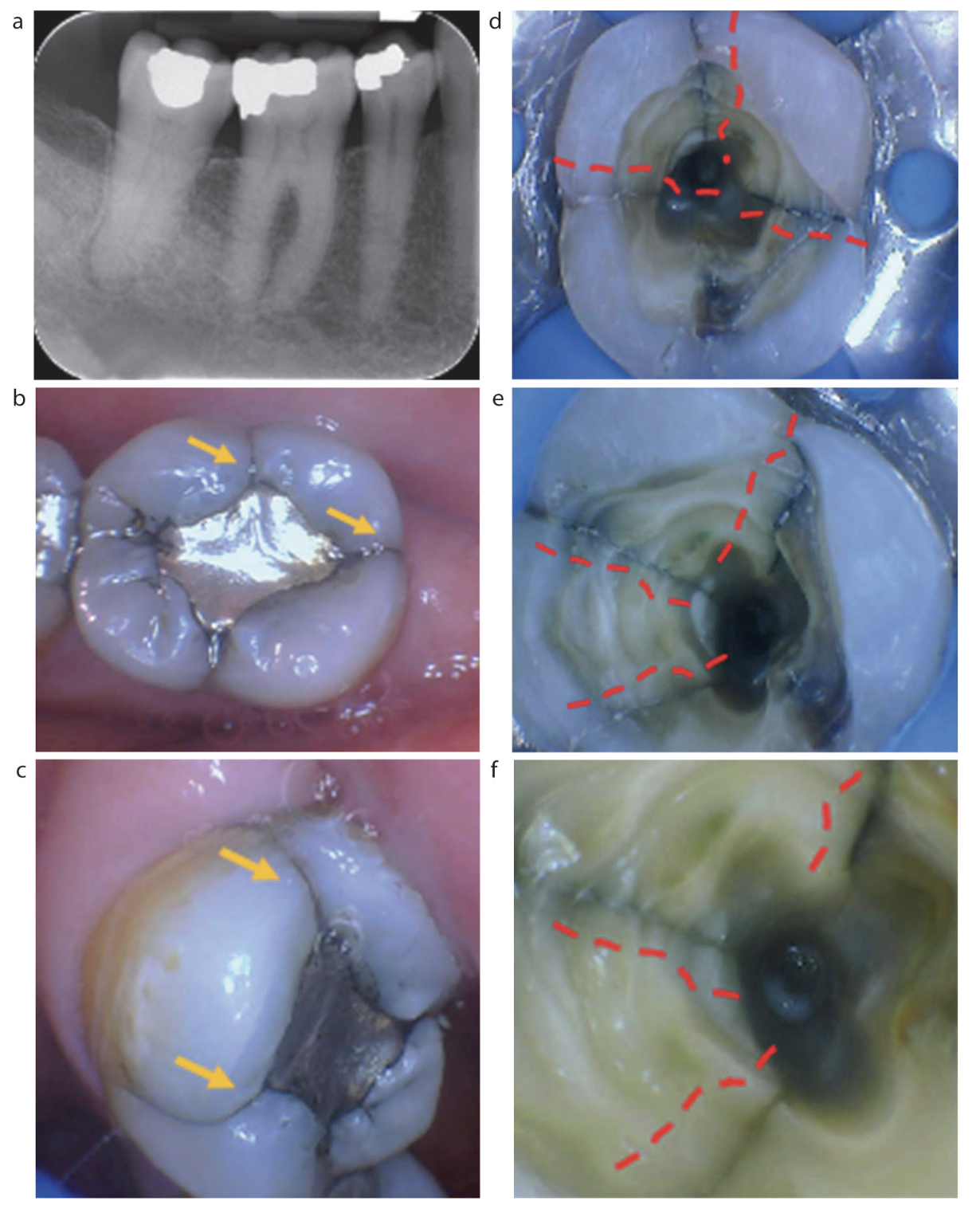 Bruxism Là Gì? Cách Chẩn Đoán Và Điều Trị Răng Nứt Do Nghiến Răng Hiệu Quả